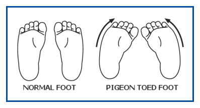 NORMAL-FOOT-VS-PIGEON-TOED-FOOT
